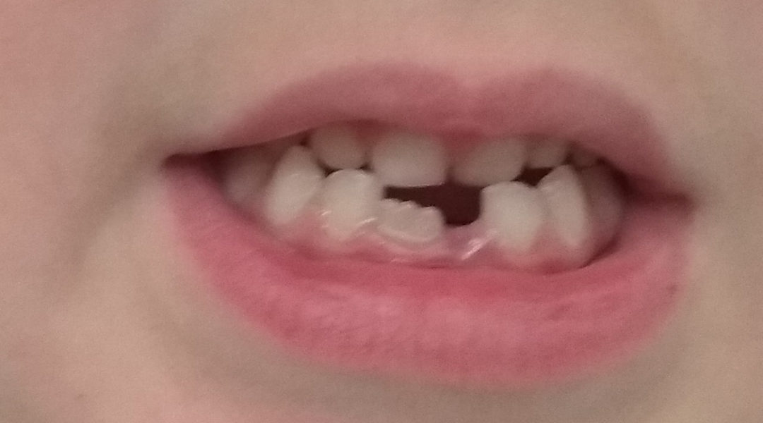 ¡Se empiezan a caer los dientes!